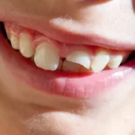 Fracturas y golpes en los dientes: qué hacer y cómo solucionarlo