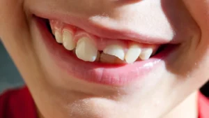 Fracturas y golpes en los dientes: qué hacer y cómo solucionarlo