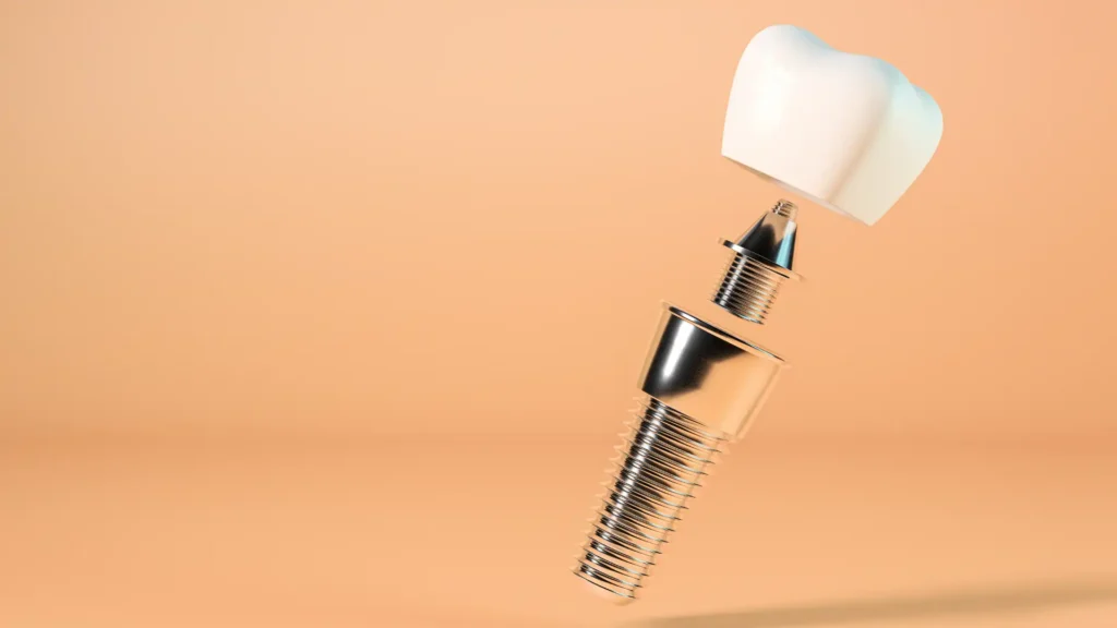 Regeneración ósea dental: la base imprescindible para unos implantes seguros