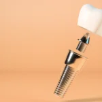 Regeneración ósea dental: la base imprescindible para unos implantes seguros