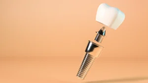 Regeneración ósea dental: la base imprescindible para unos implantes seguros